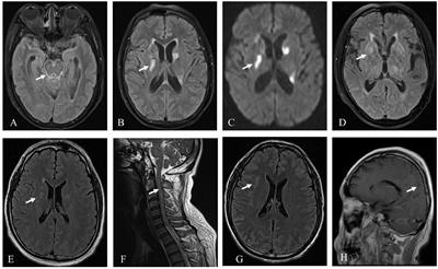 Case report: Autoimmune glial fibrillary acidic protein astrocytopathy misdiagnosed as tuberculous meningitis